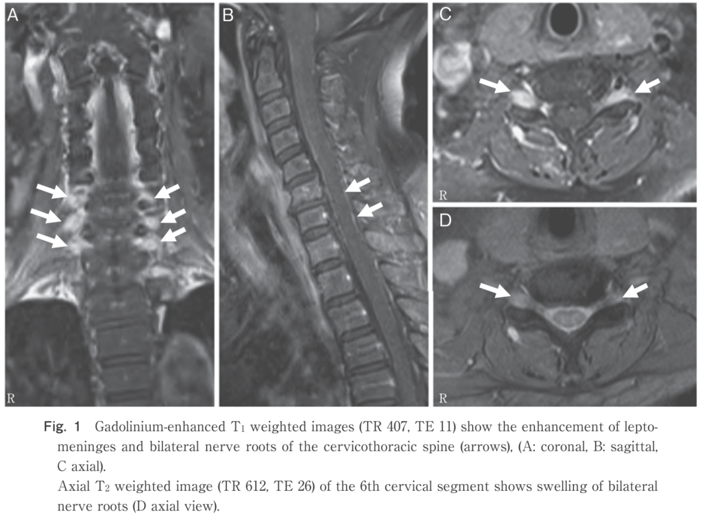 脊髄神経根 spinal nerve root 増強効果│医學事始 いがくことはじめ
