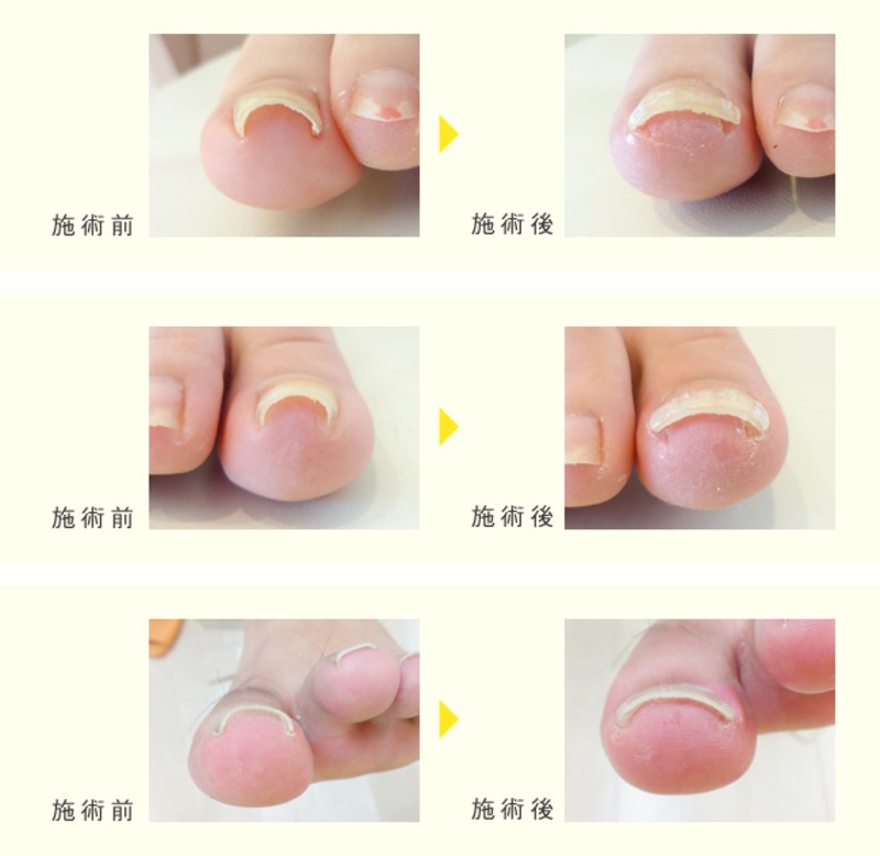 巻き爪補正ベーシックコース | 大田区西蒲田 たか整骨院