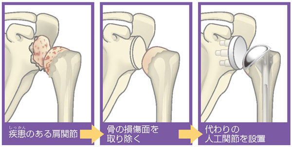 菅谷 啓之 先生 | 日本でも広がるリバース型人工肩関節 | どうしても肩