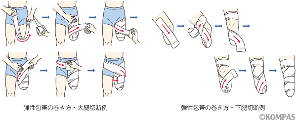 切断のリハビリテーション | KOMPAS – 慶應義塾大学病院 医療・健康