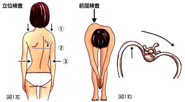 子供の側弯症について 側弯症外来 整形外科 │ 村山医療センター