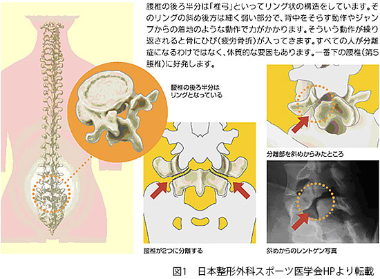 腰椎分離症(ようついぶんりしょう) │ 村山医療センター